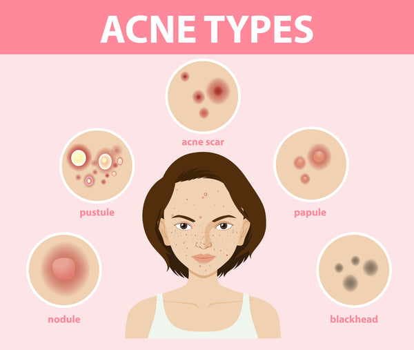 Acne
