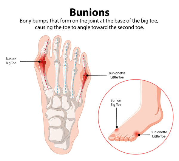 Bunions
