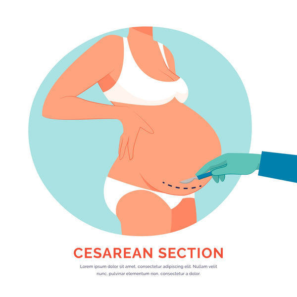 C-Sections