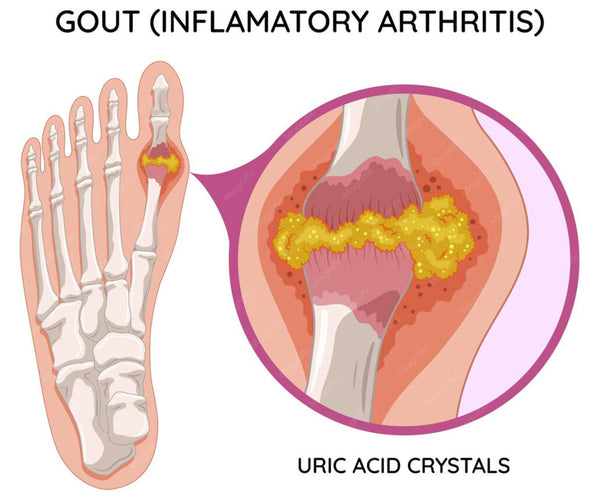 Gout