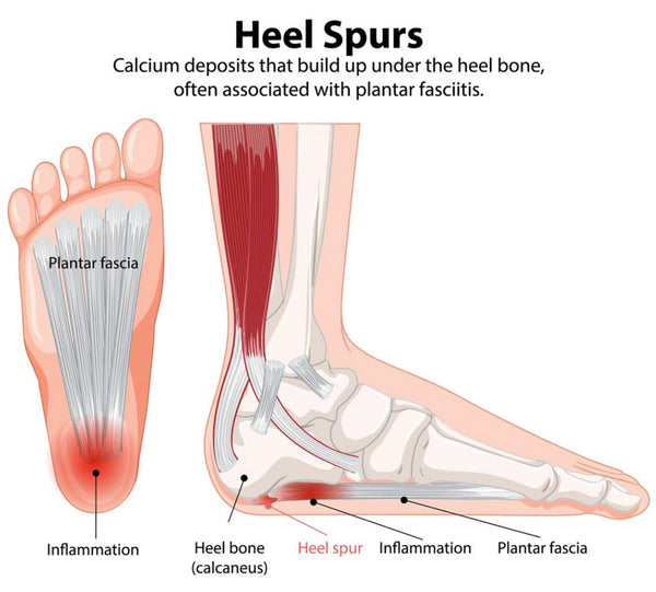 Heel Spur